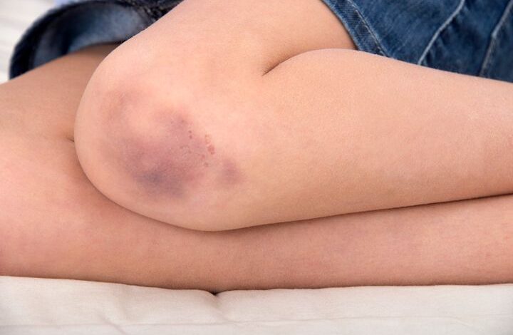 Do You Bruise So Easily? Here Are 5 Reasons Why.