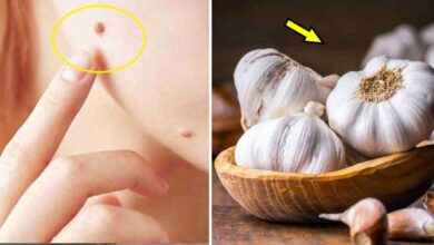 Get Rid Of Moles, Warts, And Skin Tags With These Natural Solutions