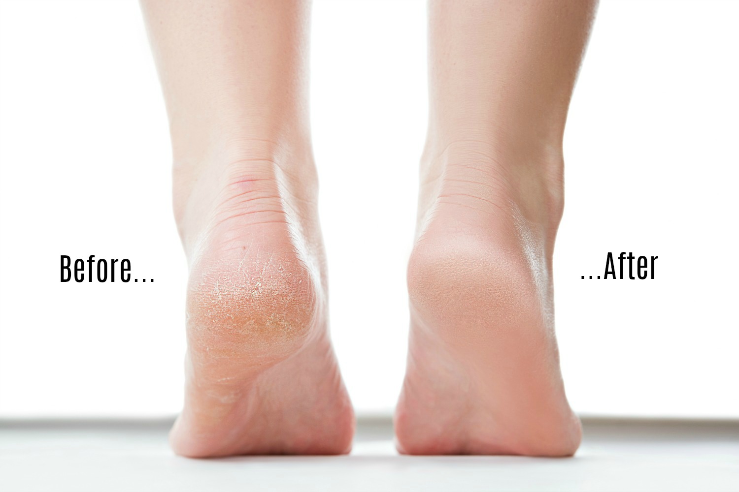 How To Easily Get Rid Of The Dry Skin At The Bottom Of Your Feet