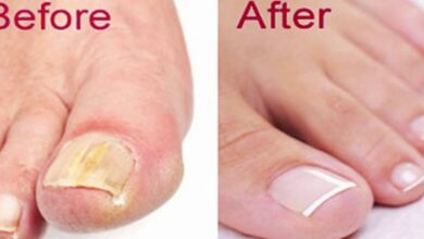 How To Get Rid Of Toenail Fungus Naturally & Fast!