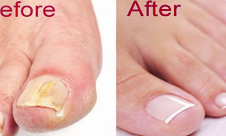 How To Get Rid Of Toenail Fungus Naturally & Fast!