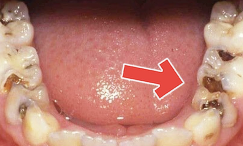How To Get Rid of Tooth Diseases And Decay Easily At Home