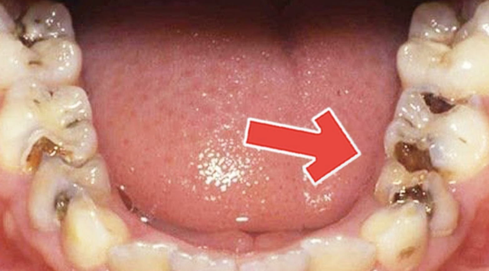 How To Get Rid of Tooth Diseases And Decay Easily At Home