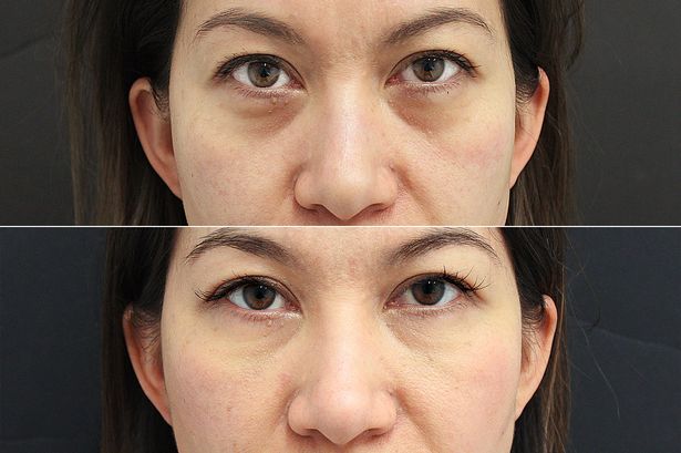 How To Get Rid Of Under-eye Bags In Only 1 Day!