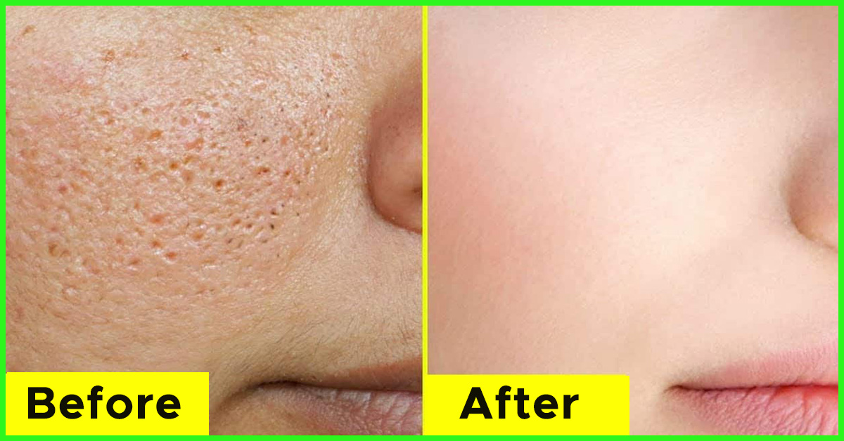 How To Minimize The Appearance Of Large Pores
