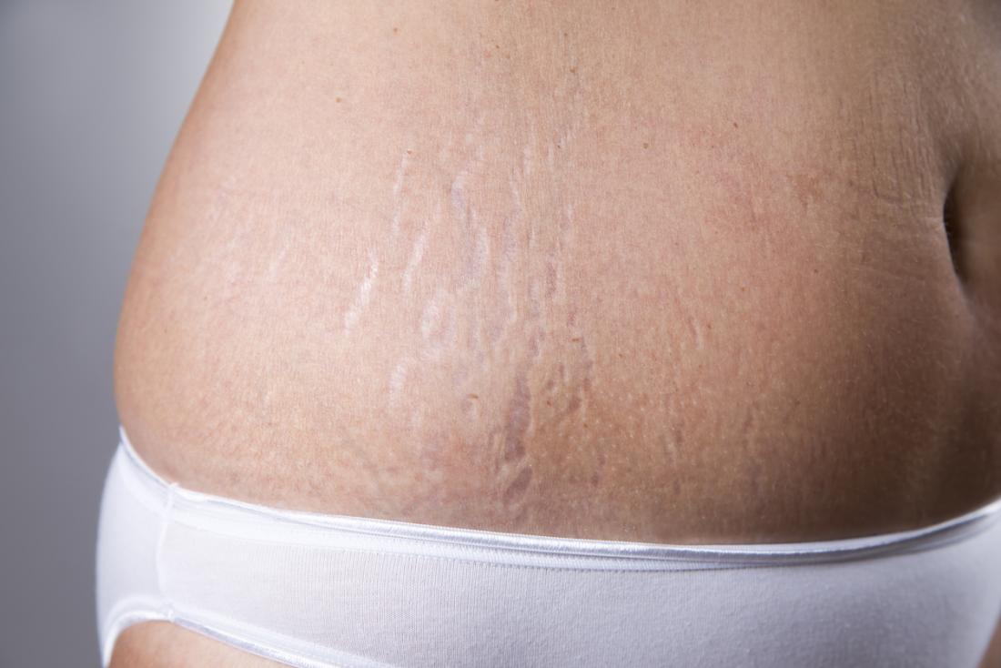 How To Remove Stretch Marks And Hide Them For Good